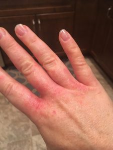 woman's light skinned hand covered in bright red histamine rash near the fingers